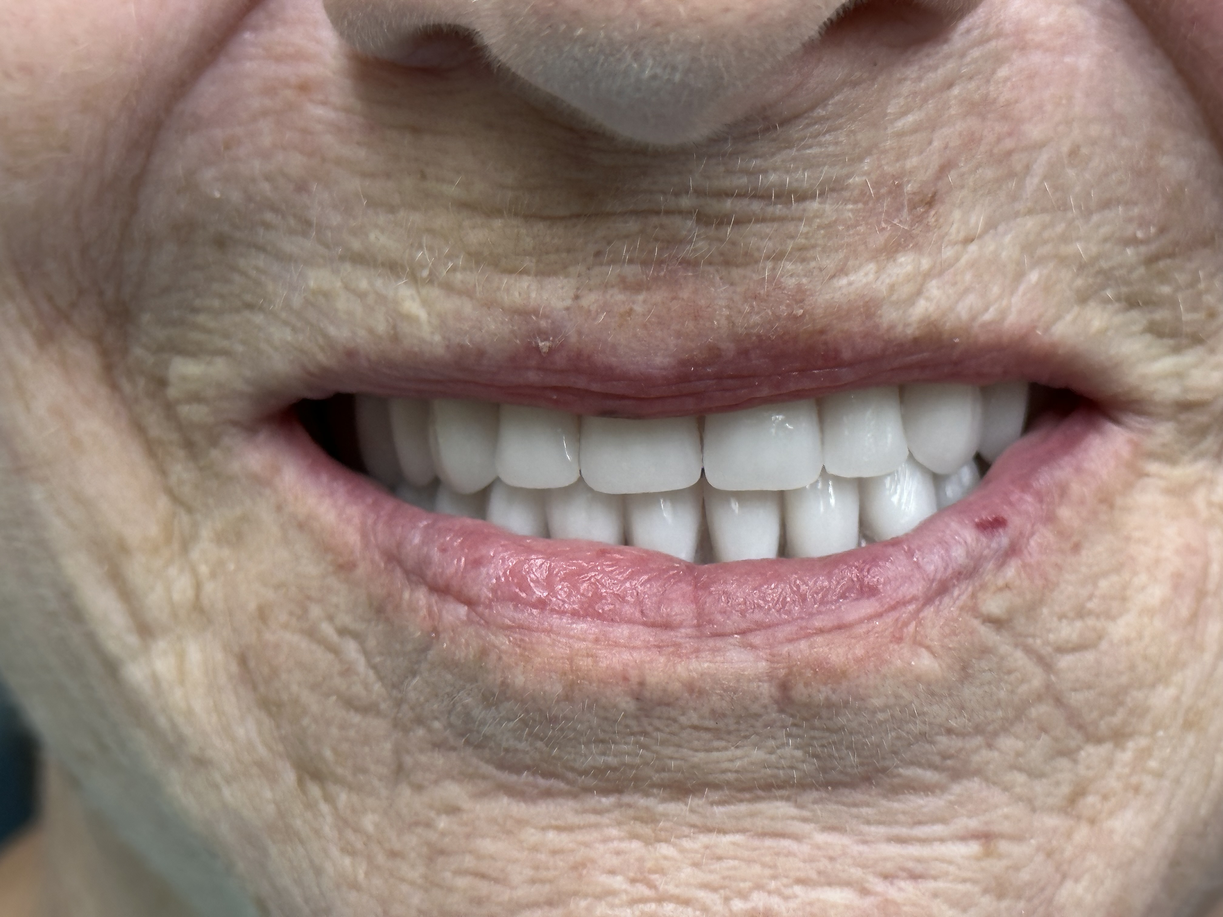 Final implant denture smile